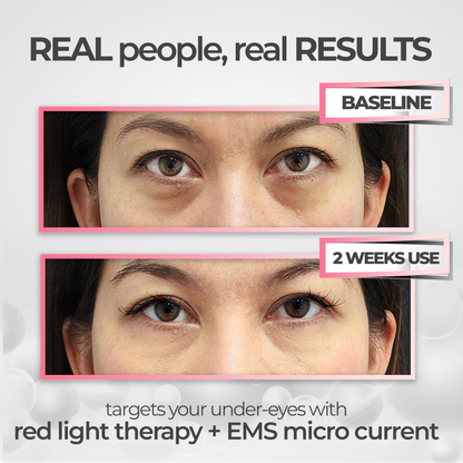 ViviRed™ Under-Eye Red Light Therapy